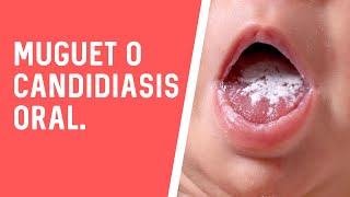 MUGUET O CANDIDIASIS ORAL [upl. by Ahsiekel690]