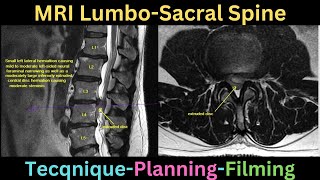 MRI Lumbo saccral spine technique plannning and filming tutorial [upl. by Fergus]