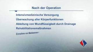 Rekonstruktion und Ersatz der Aortenklappe Teil 8  Nach der Operation [upl. by Ayekam]