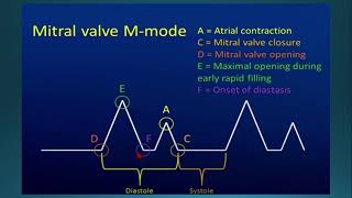 PROLAPSO DE LA VALVULA MITRAL CON EL MODO M [upl. by Gwendolin498]