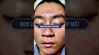 The Acne Treatment Secret HHV Clinic amp Hien Van Spa Revealed [upl. by Trah]