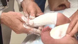 Casting of a Child With Clubfoot Using the Ponseti Method [upl. by Gautious]