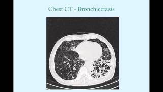 Bronchiectasis  CRASH Medical Review Series [upl. by Marnie161]