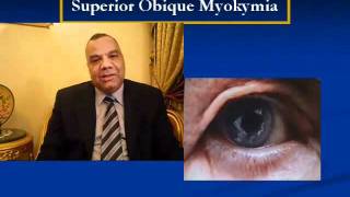 Superior Oblique Myokymia [upl. by Ayota]