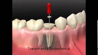 Desvitalização de dente  endodontia [upl. by Aicilef469]