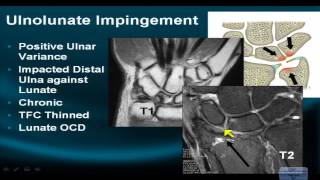 MRI Online Wrist Part VI Evaluating Impingement Syndromes of the Wrist [upl. by Jair696]