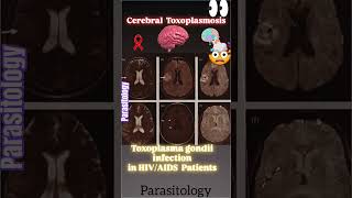 Central Nervous System CNS Toxoplasmosis in patients with HIVAIDS🎗👍Parasitology👍🔬✅ [upl. by Eradis786]