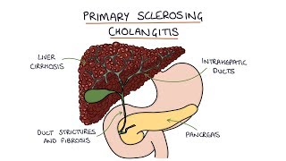 Primary Sclerosing Cholangitis Visual Explanation for Students [upl. by Ynnelg]