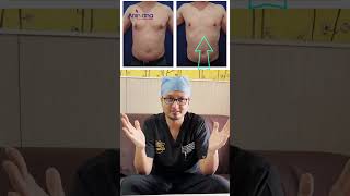 Gynecomastia Surgery Recovery Made EASY with Compression Garments [upl. by Oicelem826]