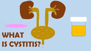 What is Cystitis [upl. by Llatsyrc325]