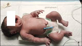 Medical Education Video Neonatology Neonatal Brachial Plexus Palsy Erb Palsy [upl. by Wincer]