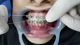 Orthodontic Ligation [upl. by Nortna]