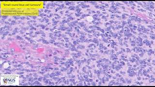 Medulloblastoma microscopy  Talking slide [upl. by Avraham104]