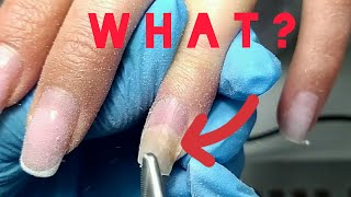 ⚡ONYCHOLYSIS of FINGERNAILS😱 Onycholysis of the nails😲 Nail exfoliation😐 shorts  Acid Primer [upl. by Armat]