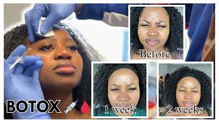 The surprising result of my BOTOX treatment [upl. by Seuqramed]