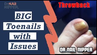 How to Treat a Big Toenail What is onycholysis Toenails with Issues [upl. by Emmalynn]