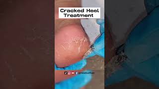 Remove Cracked Heels  So satisfying 6 mins Cracked heel treatment by miss foot fixer [upl. by Thaine707]