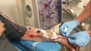 Dialysis connection of a patient with an arteriovenous fistula [upl. by Bardo44]