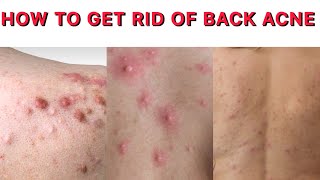 POWERFUL REMEDY FOR BACK ACNE  HOME REMEDY TO GET RID OF BACK ACNE  BACK ACNE SOLUTION [upl. by Adiaros]