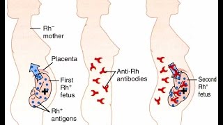 Erythroblastosis Fetalis [upl. by Annora494]