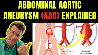 Doctor explains ABDOMINAL AORTIC ANEURYSM AAA  Symptoms risk factors treatment screening [upl. by Alys791]