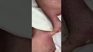 Big Cystic Acne Blackheads Extraction Blackheads amp Milia Whiteheads Removal Pimple Popping shorts [upl. by Naujid]