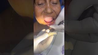 Old age patient front fix dental replacement root canal treatment  dental bridge viral dentist [upl. by Jessalin]