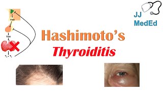 Hashimoto’s thyroiditis What Is It Whos At Risk and What You NEED to Know [upl. by Nadroj592]