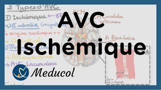 AVC ischémique causes embolie cérébrale AVC thrombose et AVC jonctionnel [upl. by Bacchus51]