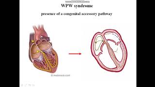 Short PR interval  ECG features of WPW syndrome [upl. by Aneelas]