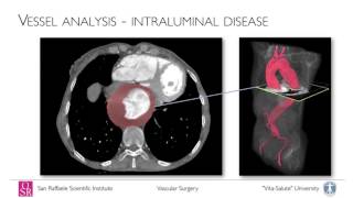 Open thoracoabdominal aortic aneurysm repair intorduciton anatomy and perioperative management [upl. by Eilyk]