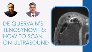 DE QUERVAINS TENOSYNOVITIS HOW TO SCAN ON ULTRASOUND [upl. by Llertnad]