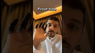 Frost bite 🥶 Explained fahadbadar2 telugu interstingfactsintelugu telugufacts [upl. by Mellette]