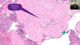 Chondroblastoma with differential diagnosis [upl. by Nnilsia]