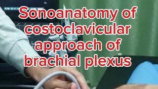 Sonoanatomy of costoclavicular approach of the brachial plexus [upl. by Ozzie]