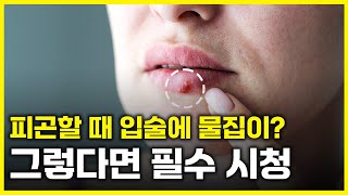 헤르페스HSV 예방 방법과 치료 방법은 아는 만큼 보인다 [upl. by Old]