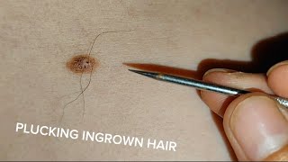 PLUCKING INGROWN HAIR and pull out underarm hair for Mr tyanchanh asmr [upl. by Freedman19]