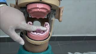 COMPLETE DENTURE 2 Secondary Impression For Edentulous Arches [upl. by Ahcirt]