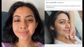 Reem Shaikh recovers from facial burns endured on set of Laughter Chefs Shares Inspirational Post [upl. by Eenobe811]