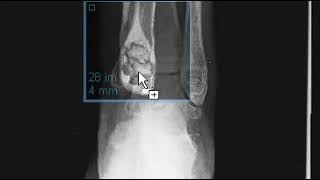 Fibrocartilaginous talocalcaneocoalition of foot [upl. by Yeo]