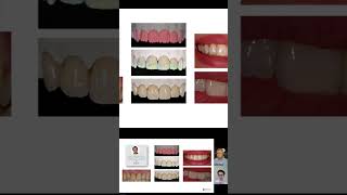 Charlamos con Eder Ramírez sobre Ceramco 3 Dentsplyprotesistadentalodontologiamoderna dentist [upl. by Nitsud]