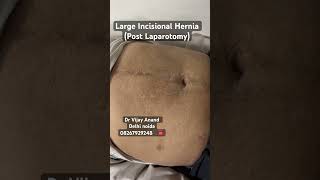 Incisional Hernia after Laparotomy Contact Dr Vijay Anandnoida hernia doctor yt 08267929248 [upl. by Eltsyek]