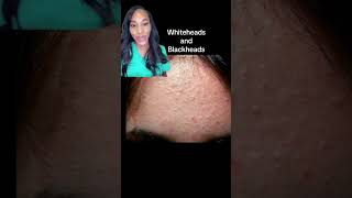 How to Get Rid of Tiny Bumps on the FaceDermatologists Tips [upl. by Niwhsa93]