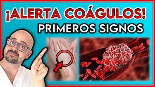 7 SÍNTOMAS que te ALERTAN de un COÁGULO en las VENAS  ¡No IGNORES estos SÍNTOMAS [upl. by Fabron]