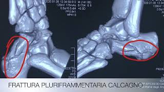 Case report frattura pluriframmentaria del calcagno [upl. by Jamill]