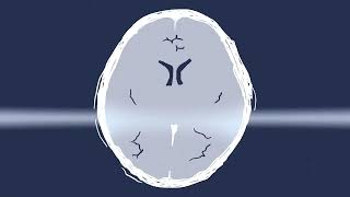 Comment lencéphalite estelle diagnostiquée   How is encephalitis diagnosed  French [upl. by Savell]