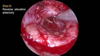 ENDOSCOPIC TWO HANDED INTERLAY TYMPANOPLASTY By DrJego Ori [upl. by Enahsal]