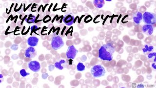 Juvenile Myelomonocytic Leukemia JMML Peripheral Blood Smear 2 year old Hematology amp Hemepath [upl. by Sueddaht]