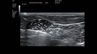 Paediatric popliteal block [upl. by Ttimme]