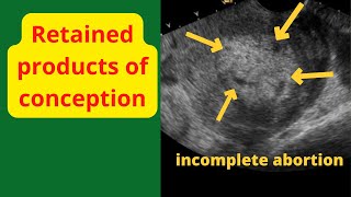 Incomplete abortion RPOCs After Miscarriage at 12 weeks pregnancy  Ultrasound case [upl. by Paola]